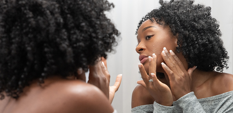Magic or Myth: Acne