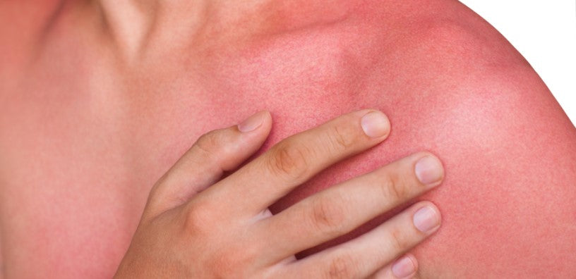 7 Tips to Treat Sunburn
